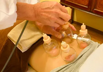 吸い玉（カッピング）施術の様子